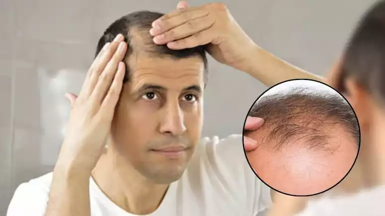 Hair Regrowth Serum Hindi